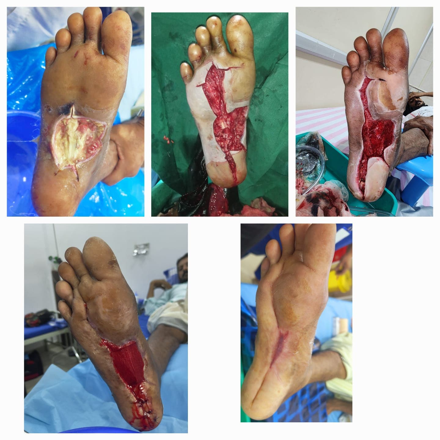Before and after clinical results of wound healing and limb salvage